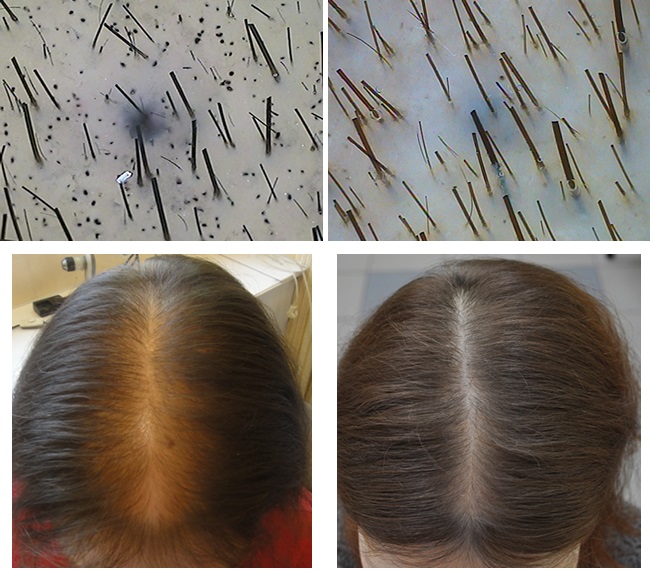 Νικοτινικό οξύ σε ταμπλέτες μαλλιών, μάσκες για ανάπτυξη. Οδηγίες χρήσης, κριτικές γιατρών