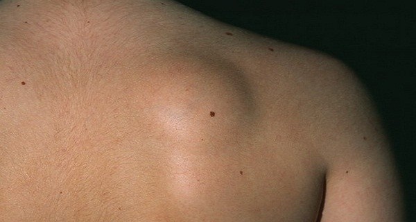 Nowotwory skóry: zdjęcia i opisy na głowie, ramionach, twarzy i ciele. Jak leczyć łagodne i złośliwe nowotwory