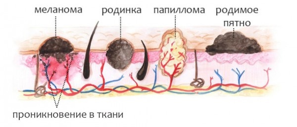 Néoplasmes cutanés: photos et descriptions sur la tête, les bras, le visage et le corps. Comment traiter les néoplasmes bénins et malins