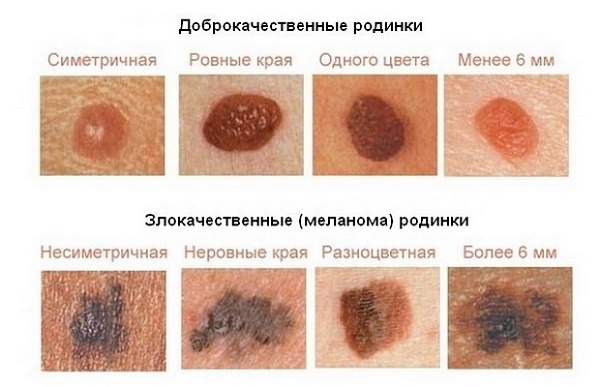 Ung thư da: hình ảnh và mô tả trên đầu, cánh tay, mặt và cơ thể. Cách điều trị ung thư lành tính và ác tính