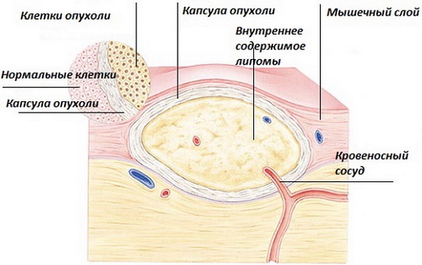 Deri neoplazileri: baş, kollar, yüz ve vücuttaki fotoğraflar ve açıklamalar. İyi huylu ve kötü huylu neoplazmalar nasıl tedavi edilir