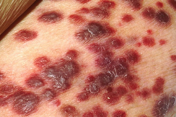 Skin neoplasms: photos and descriptions on the head, arms, face and body. How to treat benign and malignant neoplasms