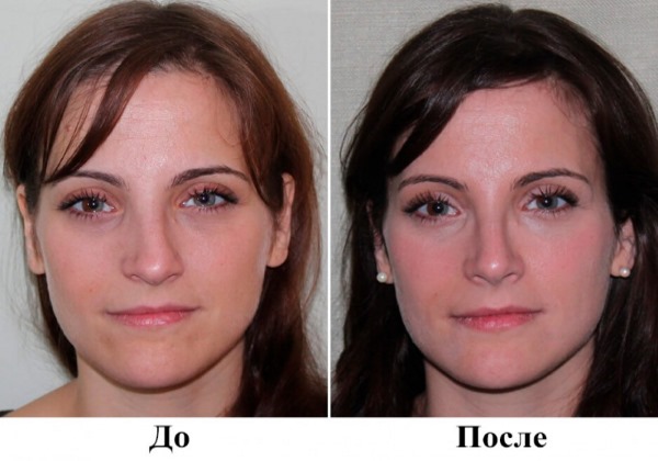Cirurgia de l’envà nasal: postoperatori, cura del nas després de la correcció, rehabilitació. Una foto