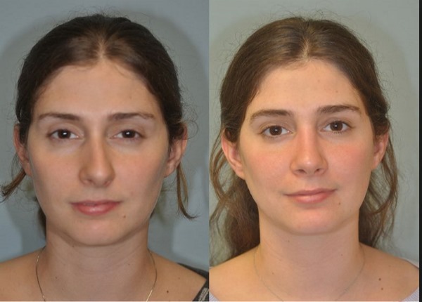 Chirurgie de la cloison nasale: période postopératoire, soins du nez après correction, rééducation. Une photo