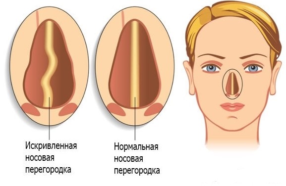 Cirurgia de septo nasal: pós-operatório, cuidados com o nariz após correção, reabilitação. Uma foto