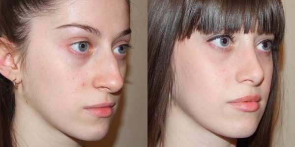 Pembedahan pengurangan hidung: sayap, hujung, bagaimana ia dilakukan, sebelum dan selepas foto