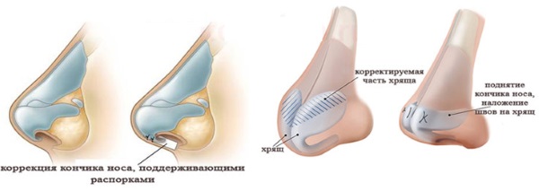 Chirurgia di riduzione del naso: ali, punta, come si fa, foto prima e dopo
