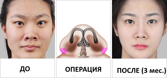 Pembedahan pengurangan hidung: sayap, hujung, bagaimana ia dilakukan, sebelum dan selepas foto