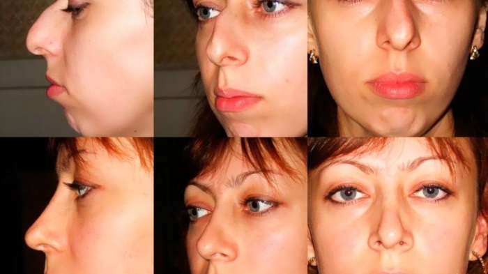 Cirurgia de reducció del nas: ales, punta, com ho fan, abans i després de les fotos