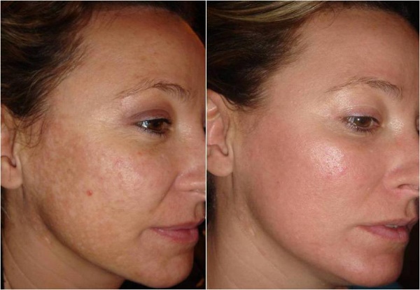 Peelings acides pour le visage: formulations professionnelles à usage domestique. Efficacité et utilisation