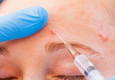 A pattanások okai a homlokán nőknél, melyik szerv nem megfelelő? Hogyan lehet megszabadulni otthon, kezelés
