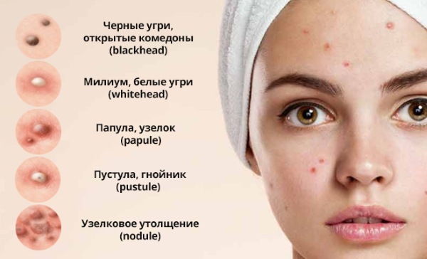 Causas del acné en la frente en las mujeres, ¿qué órgano no está en orden? Cómo deshacerse de en casa, tratamiento.
