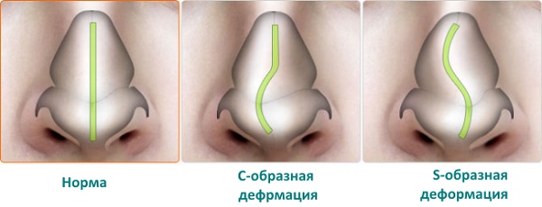 Ринопластика носа, нехируршка, затворена, отворена, реконструктивна, ињекција, рехабилитација