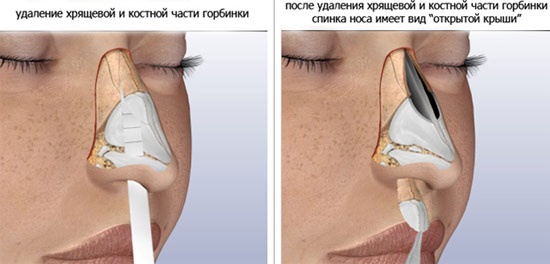 Rinoplàstia del nas, no quirúrgica, tancada, oberta, reconstructiva, injectable, rehabilitadora