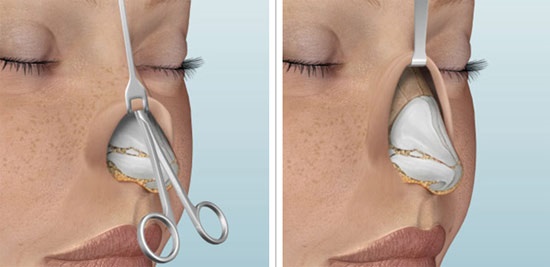 Ρινοπλαστική της μύτης, μη χειρουργική, κλειστή, ανοιχτή, επανορθωτική, ένεση, αποκατάσταση