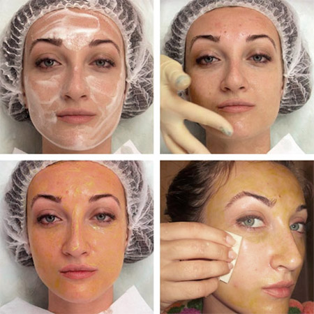 Peeling salicílico para la cara: qué es, efectividad, cómo se hace. Recetas de remedios caseros