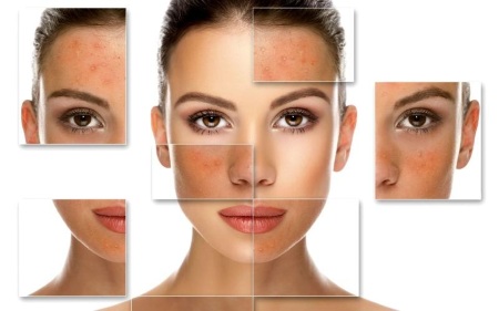 Салицилни пилинг за лице - шта је то, ефикасност, како се то ради. Рецепти за кућне лекове