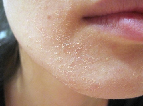Salicyl-Peeling für das Gesicht - was ist das, Wirksamkeit, wie wird es gemacht? Hausmittel Rezepte