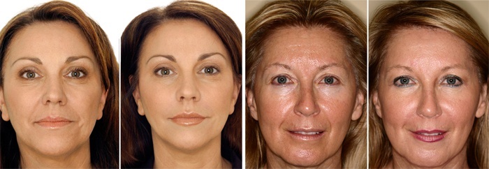 Solcoseryl för ansiktet från rynkor: recensioner av kosmetologer, vad är bättre gel eller salva, hur man applicerar hemma