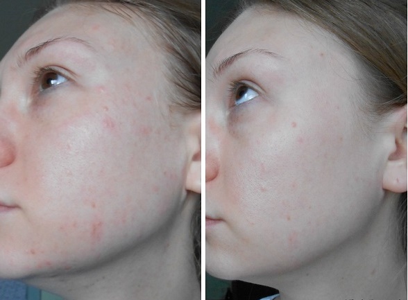 Solcoseryl na obličej od vrásek: recenze kosmetologů, co je lepší gel nebo mast, jak používat doma
