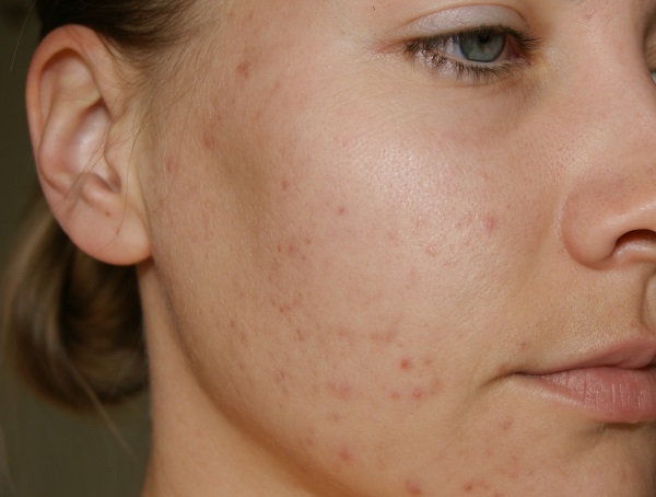 Remedies voor acnevlekken op het gezicht. De beste in de apotheek en effectieve mensen. Hoe pigmentvlekken thuis snel te verwijderen