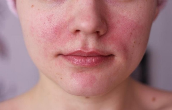 Remedies voor acnevlekken op het gezicht. De beste in de apotheek en effectieve mensen. Hoe pigmentvlekken thuis snel te verwijderen