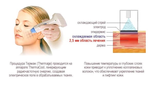 Ansiktsbehandling - vad är detta förfarande, hur görs det, vad är skillnaden med RF-lyft. Foton, resultat, pris, recensioner