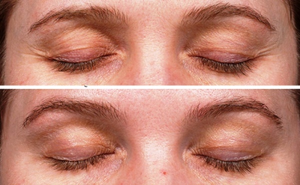 Thermage facial: quin és aquest procediment, com es fa, quina diferència hi ha amb l'aixecament de RF. Fotos, resultats, preu, ressenyes