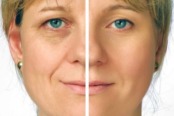 Thermage facial: què és aquest procediment, com es fa, quina diferència hi ha amb l'aixecament de RF. Fotos, resultats, preu, ressenyes