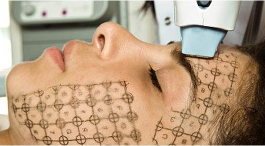 Termaje facial: qué es este procedimiento, cómo se hace, cuál es la diferencia con el levantamiento de RF. Fotos, resultados, precio, reseñas