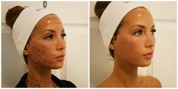 Tepelné ošetrenie tváre - aký je tento postup, ako sa to robí, aký je rozdiel pri RF-liftingu. Fotky, výsledky, cena, recenzie