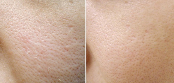 Acido acetilsalicilico per la pelle del viso. Ricette per maschere, peeling per l'acne, rughe. Risultati e foto