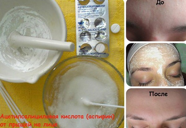 Acetilsalicilo rūgštis veido odai. Kaukių receptai, šveitimas nuo spuogų, raukšlių. Rezultatai ir nuotraukos