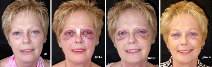 Blepharoplasty. Photos after surgery by day. Complications, recovery after circular, lower, upper. Rehabilitation, consequences