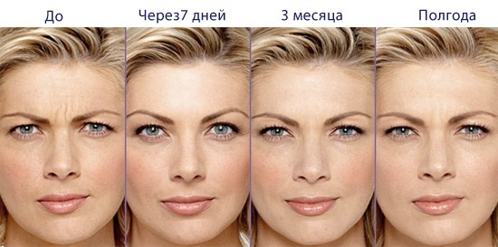 Injekcije botoxa za bore na licu. Fotografije prije i poslije, cijena, posljedice, kontraindikacije postupka