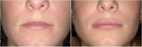 Botox injekciók arc ráncok ellen. Fotók előtt és után, ár, következmények, az eljárás ellenjavallatai