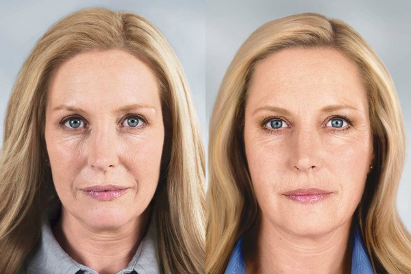 Botox-injektioner för ansiktsrynkor. Före och efter bilder, pris, konsekvenser, kontraindikationer av proceduren