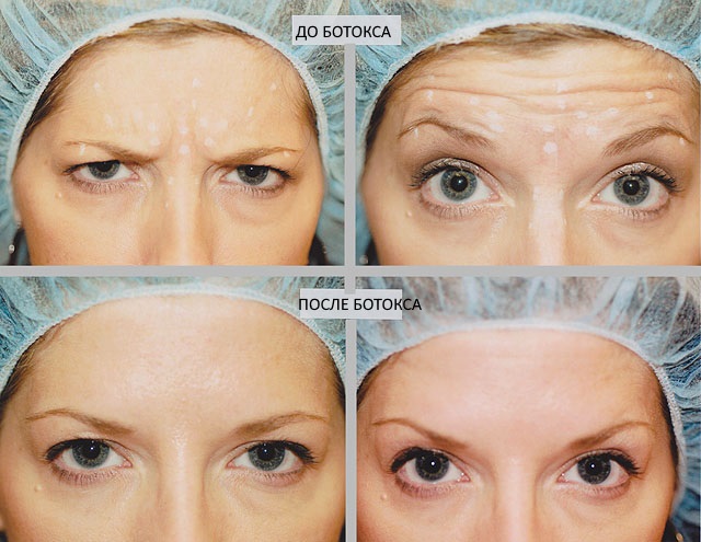Ενέσεις Botox για ρυτίδες στο πρόσωπο. Πριν και μετά τις φωτογραφίες, την τιμή, τις συνέπειες, τις αντενδείξεις της διαδικασίας