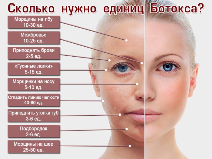 Injeccions de botox per a les arrugues facials. Abans i després de les fotos, preu, conseqüències, contraindicacions del procediment