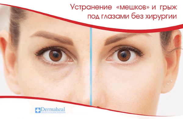 Dermahil för påsar under ögonen i HSR mesoterapi. Recensioner av kosmetologer