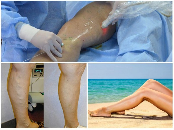 Eliminació per làser de venes de cames amb varius. Com va l'operació, el postoperatori, la rehabilitació, les conseqüències, les complicacions