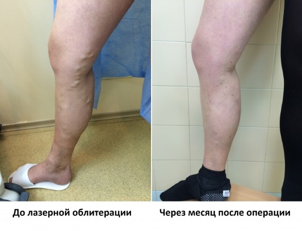 Ablation laser des veines des jambes avec varices. Comment se déroule l'opération, la période postopératoire, la rééducation, les conséquences, les complications