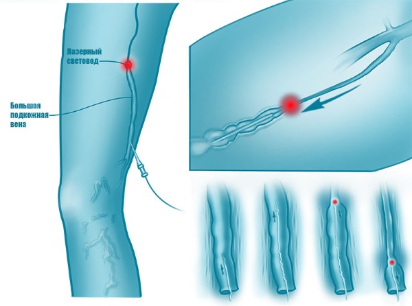 Laserverwijdering van beenaders met spataderen. Hoe verloopt de operatie, de postoperatieve periode, revalidatie, gevolgen, complicaties
