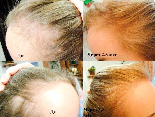 Les meilleurs remèdes contre la chute de cheveux chez les femmes pendant la grossesse, l'allaitement, après l'accouchement, la coloration, la chimiothérapie, les perturbations hormonales