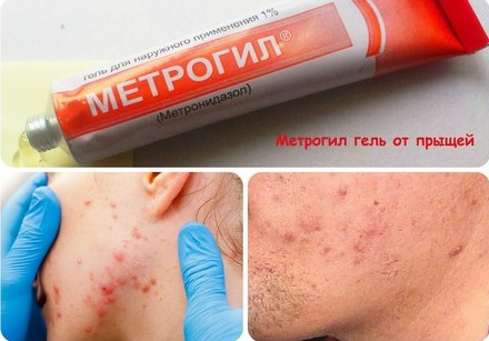 Metrogyl acne-gel. Recensies van artsen en kopers, samenstelling, effectiviteit, gebruiksaanwijzing