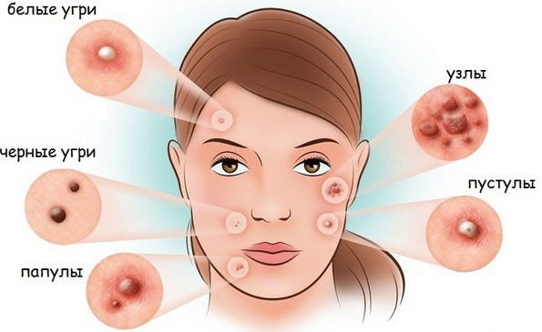 Gel per l'acne Metrogyl. Recensioni di medici e acquirenti, composizione, efficacia, istruzioni per l'uso