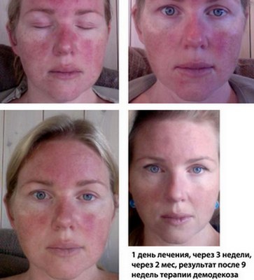 Metrogyl acne-gel. Recensies van artsen en kopers, samenstelling, effectiviteit, gebruiksaanwijzing