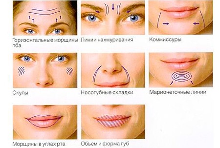 Mesovarton để phục hồi sinh học cho khuôn mặt. Thành phần của thuốc, nhà sản xuất, hậu quả, đánh giá của các chuyên gia thẩm mỹ và giá cả