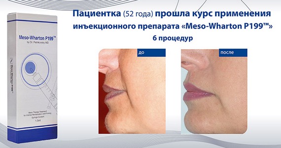 Mesovarton for face biorevitalization. Composition of the drug, manufacturer, consequences, reviews of cosmetologists and price