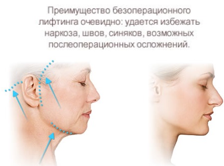 Cirurgia plàstica facial. Fotos abans i després de la cirurgia de contorn amb àcid hialurònic. Preus, ressenyes